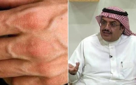 هل شرايين اليد تدل على الإصابة بأمراض القلب