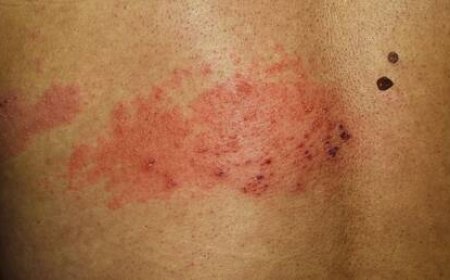 أخصائية أورام الأطفال تحدد الشامات الخطرة