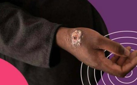 الصحة العالمية: هناك انتشار لمرض الليشمانيا في اليمن