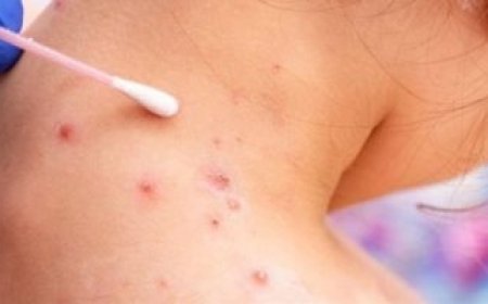 هل جدري القردة مثل وباء كورونا؟.. منظمة الصحة العالمية تجيب