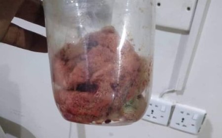خطأ طبي في حضرموت.. نسيان شاش داخل مريضة يثير غضباً واسعاً