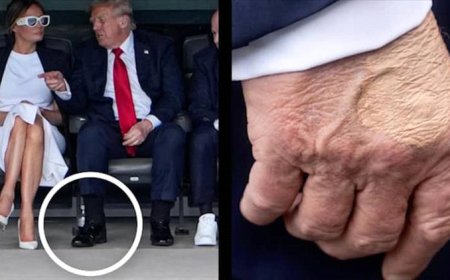 ضغوط سياسية وكدمات مثيرة للجدل.. تفاصيل جديدة عن صحة ترامب