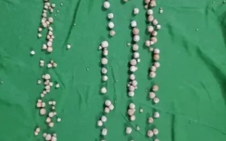 إنجاز طبي نادر في شبوة.. استخراج 193 حصوة من مثانة مريض دون جراحة مفتوحة